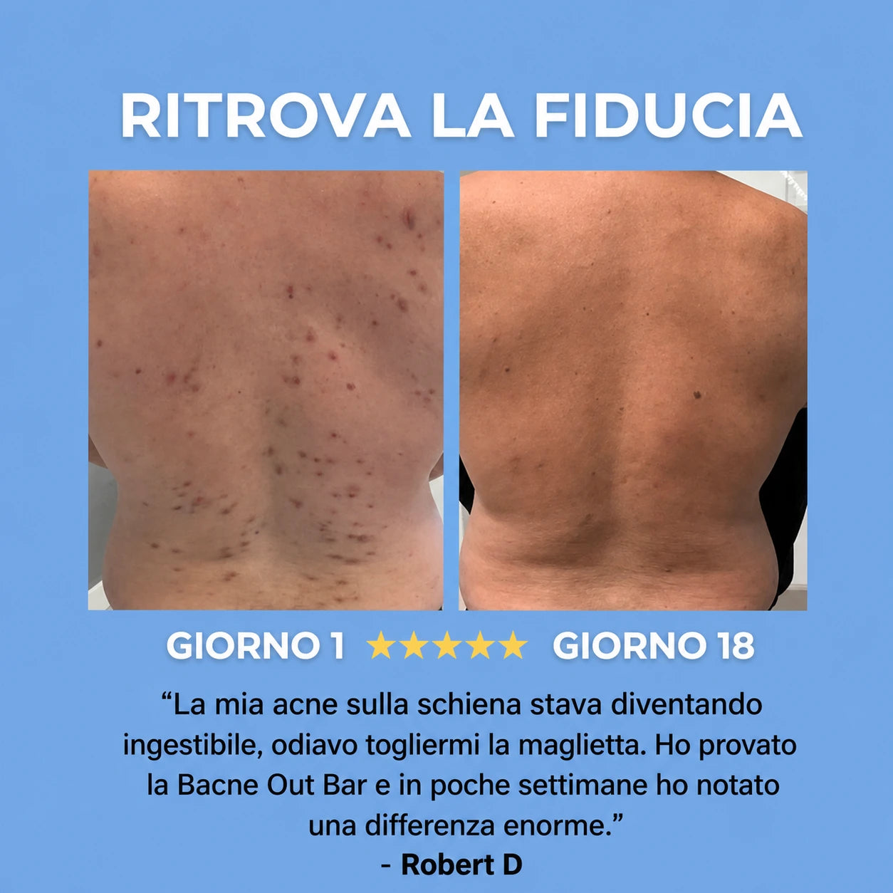 SAPONE ANTI-ACNE™