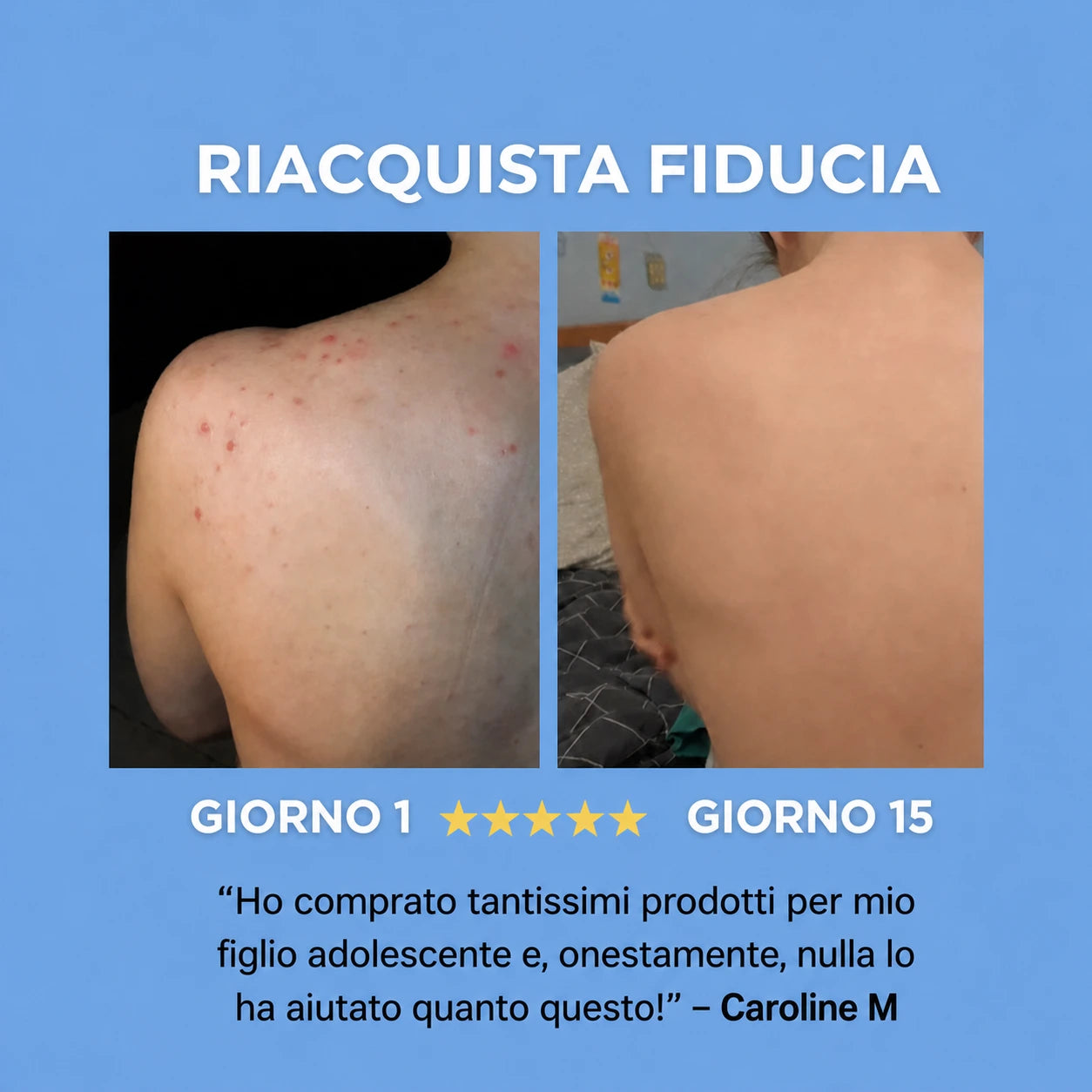 SAPONE ANTI-ACNE™